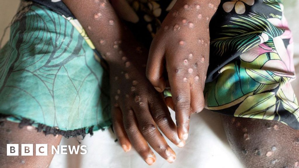 Mpox in Africa: New strain declared a continental public health emergency – BBC.com