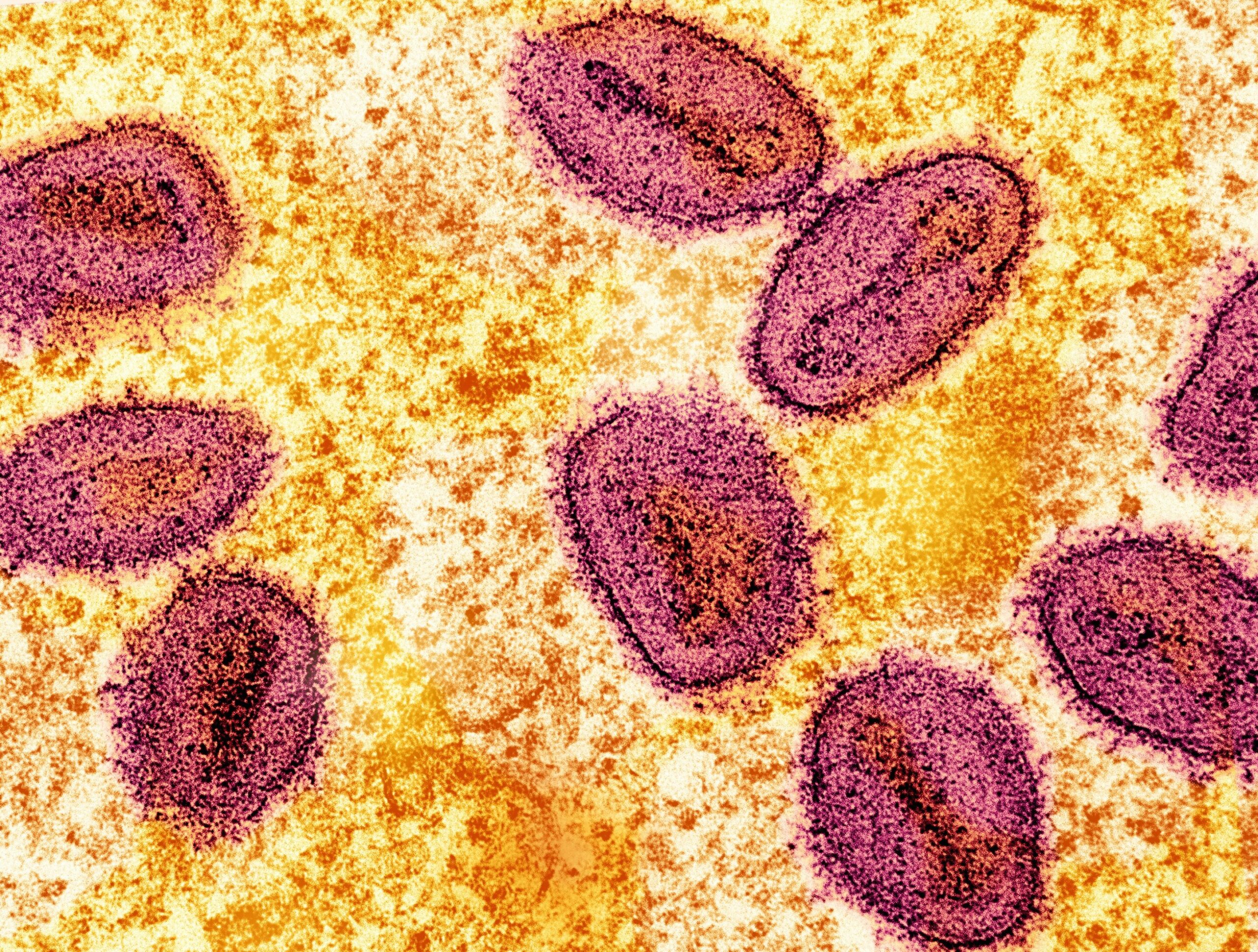 WHO warns more mpox to come in Europe after case in Sweden – Medical Xpress