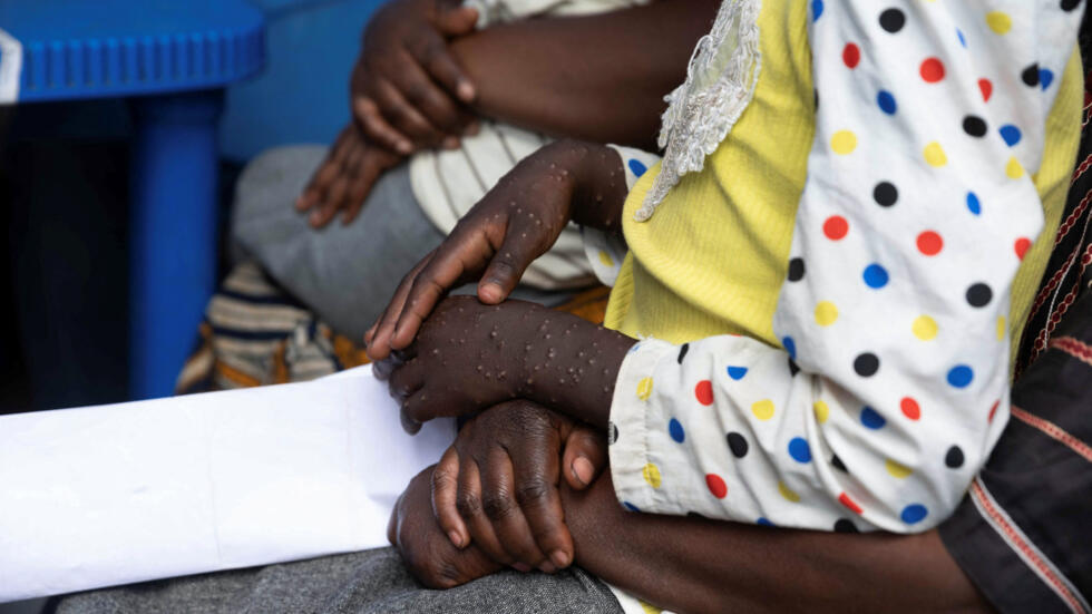 WHO reports 30,000 suspected mpox cases in Africa, mainly in DRC – RFI English